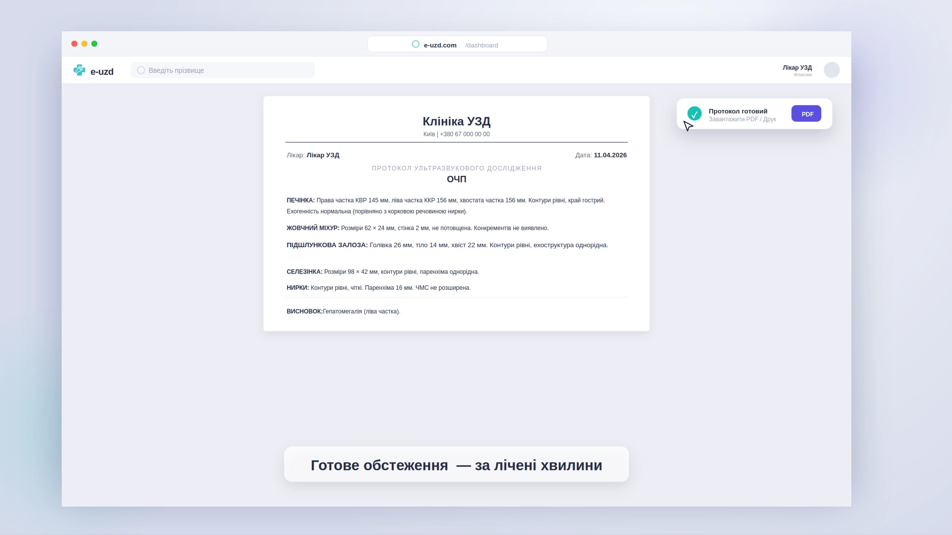 Готовий протокол УЗД у PDF